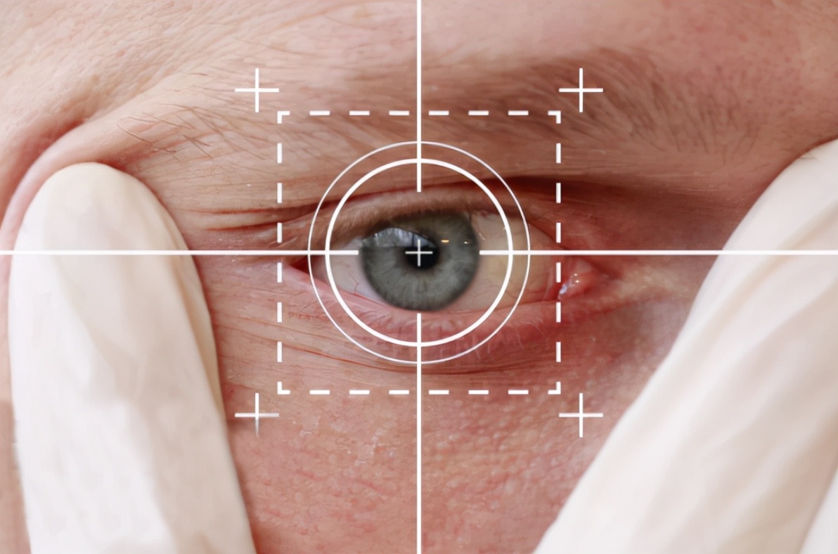 全激光近视手术术后恢复,近视手术术后恢复