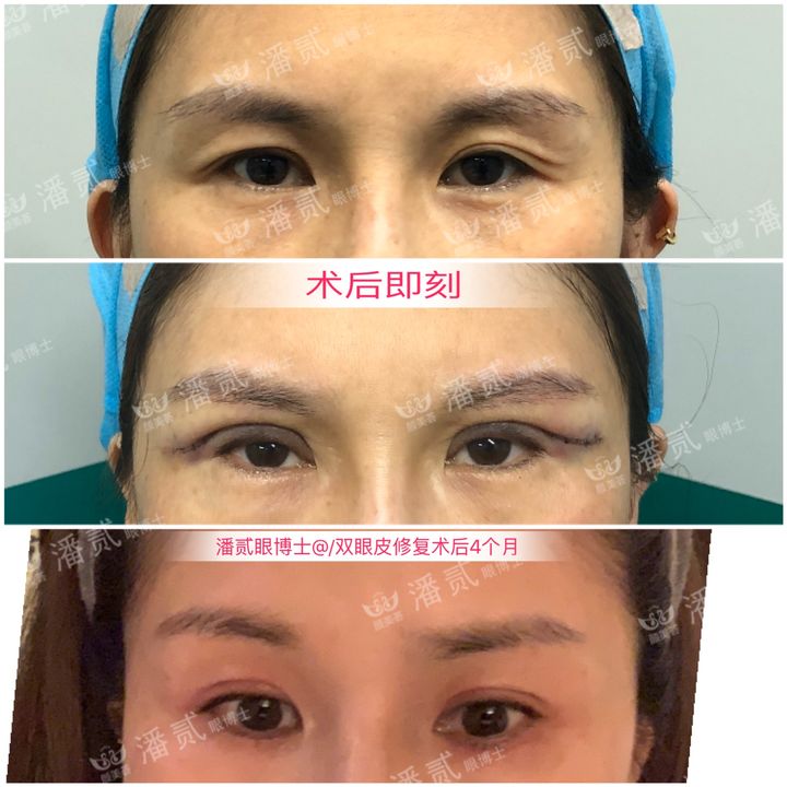 割了开扇双眼皮眼尾上扬太宽,眼尾上扬的眼睛适合什么双眼皮