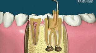 根管治疗第四步骤,根管治疗案例分享话术