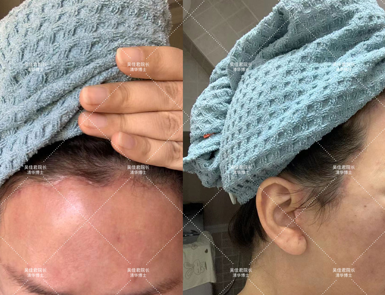 54岁姐姐分享大拉皮术后恢复历程,48岁做拉皮手术的真实经历