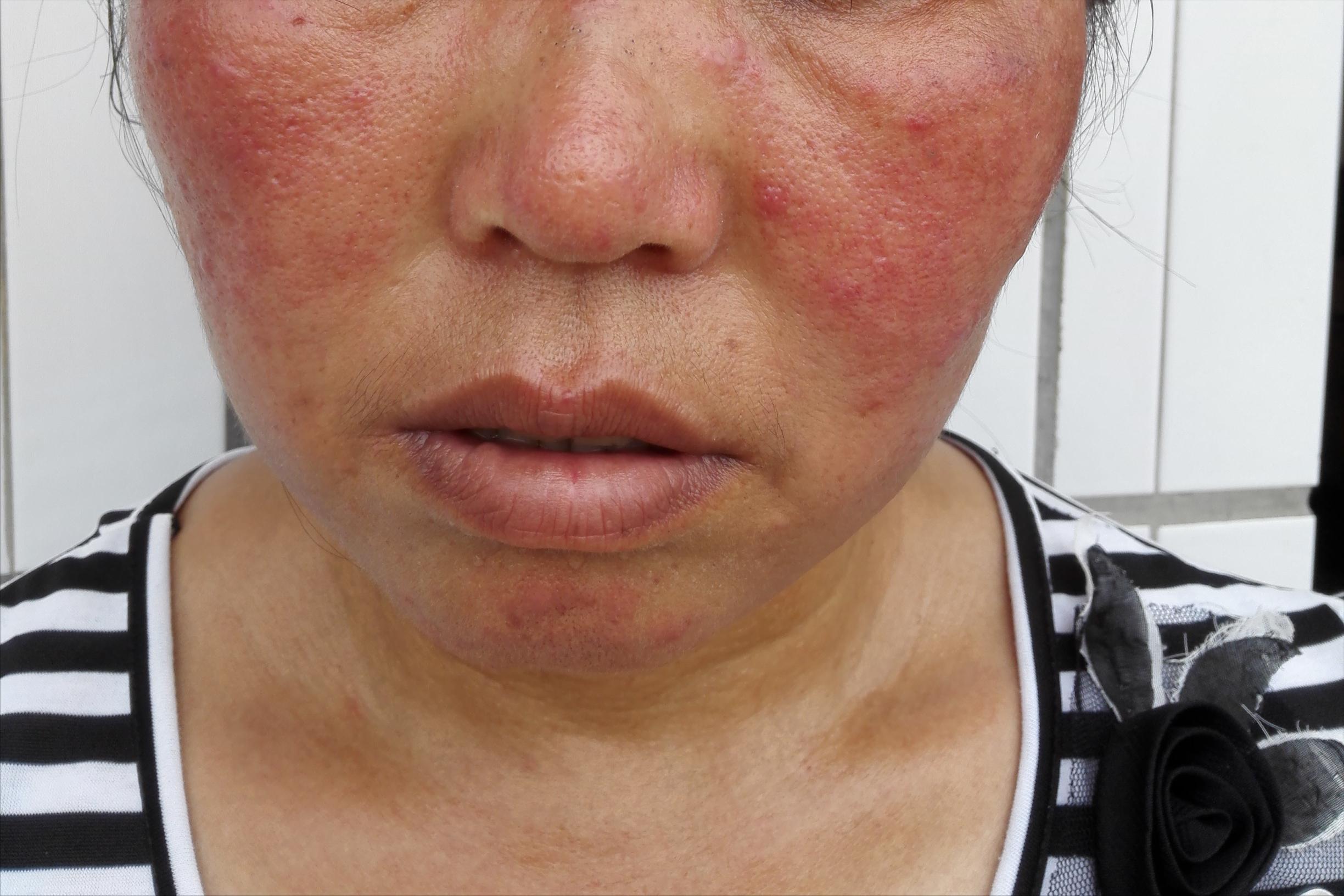 激素依赖性皮炎擦哪种药膏好,脸部过敏性皮炎十大药膏不含激素