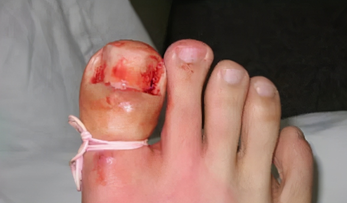 拔甲可以彻底治好嵌甲性甲沟炎吗,嵌甲甲沟炎拔了指甲还是红肿有脓