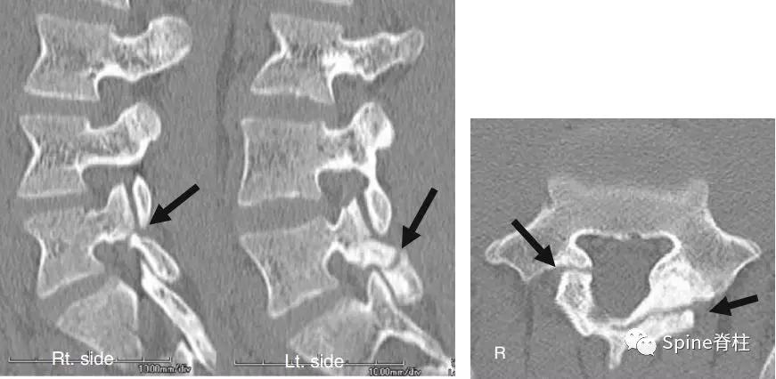 青少年一跑步就腰痛,青少年腰痛是什么原因引起的