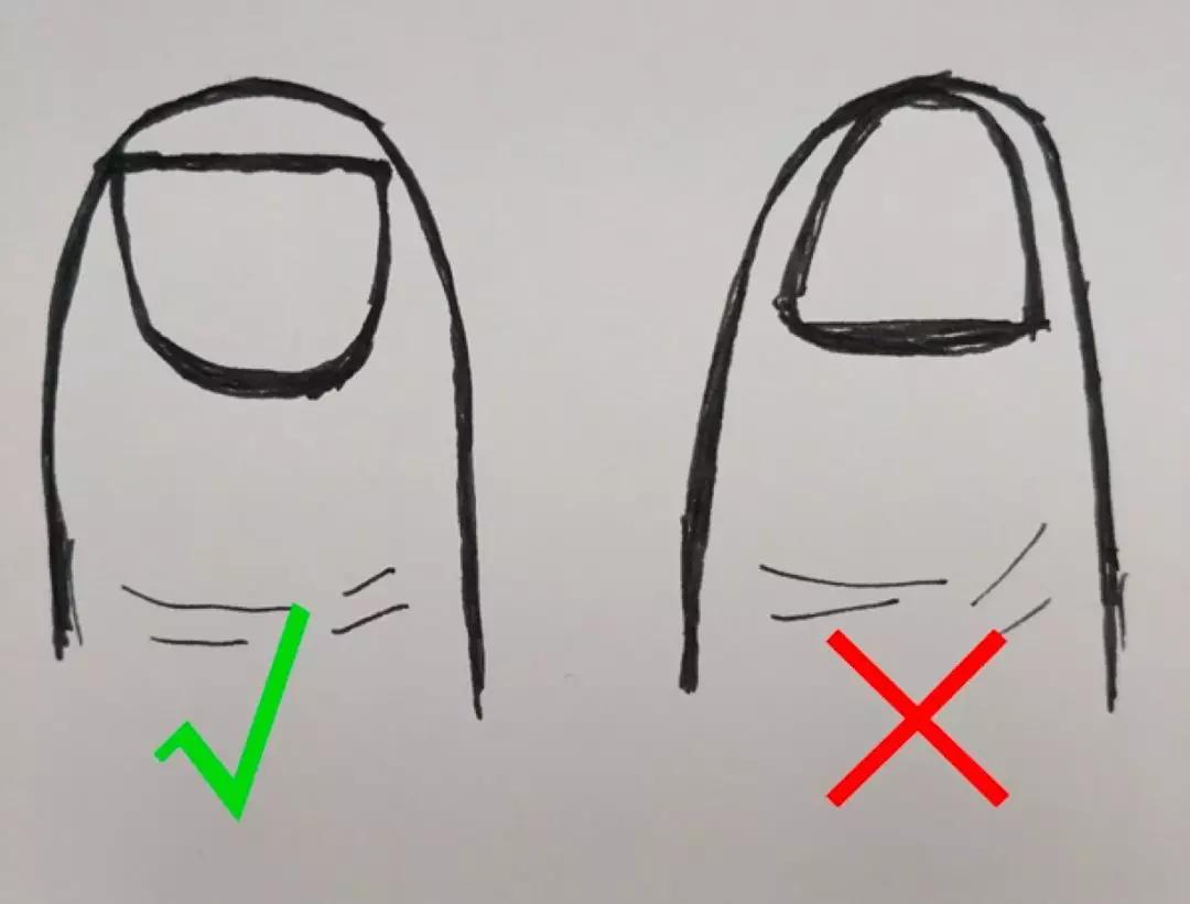 宝宝脚趾甲往肉里长怎么办,宝宝脚趾甲往肉里长怎么干预