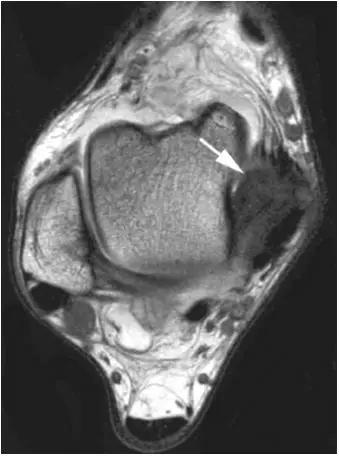 踝关节撞击症问诊,踝关节撞击综合征的x线表现
