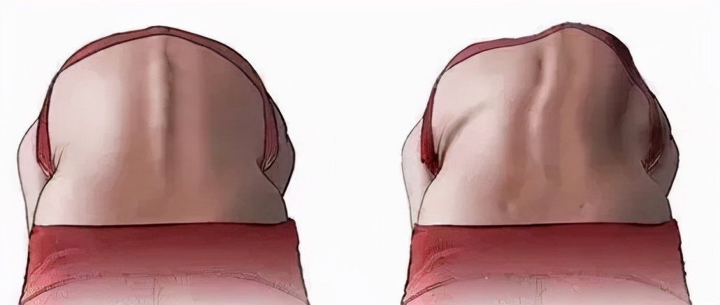 脊柱无侧弯但两侧腰线不对称,两边腰线弧度不一样是脊柱侧弯吗