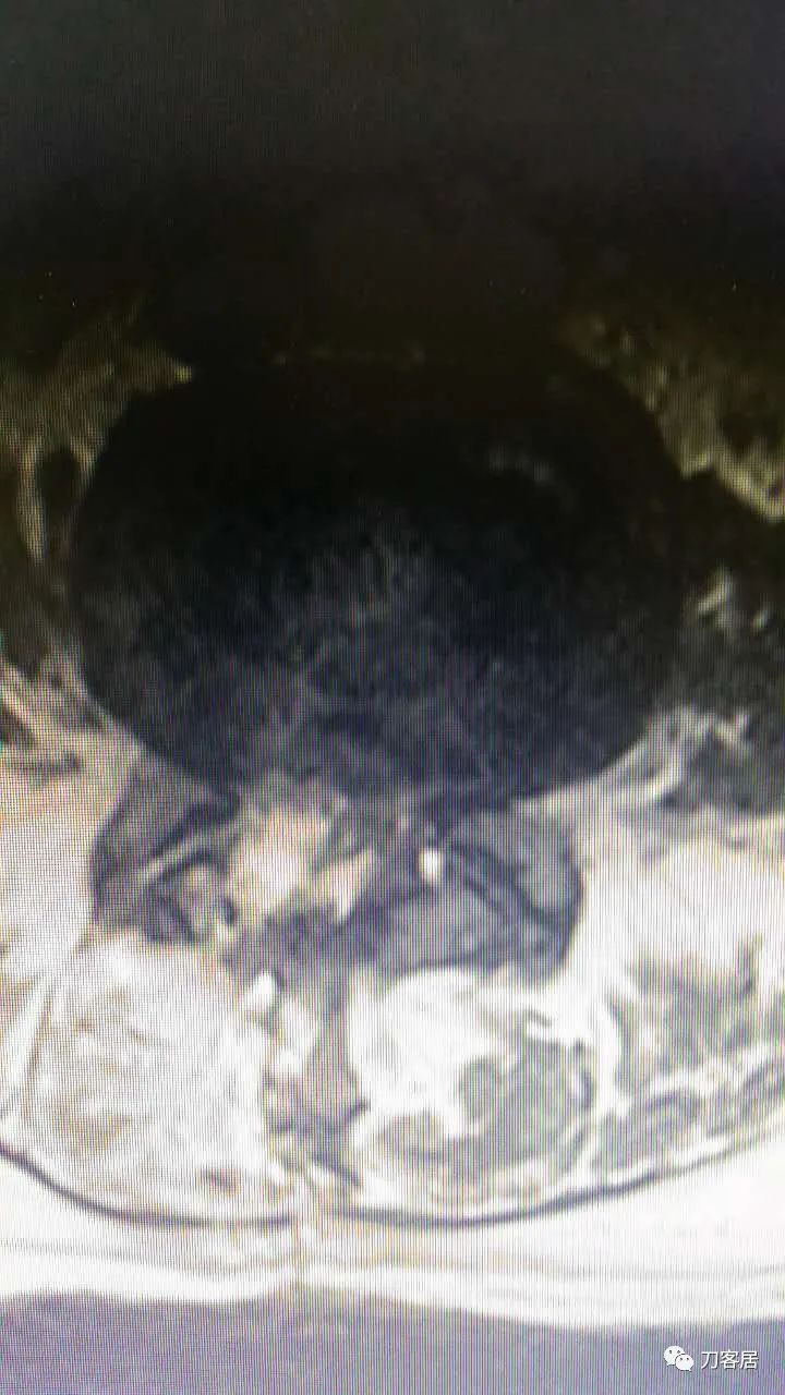 腰椎手术切掉棘突,腰突微创后出血肿