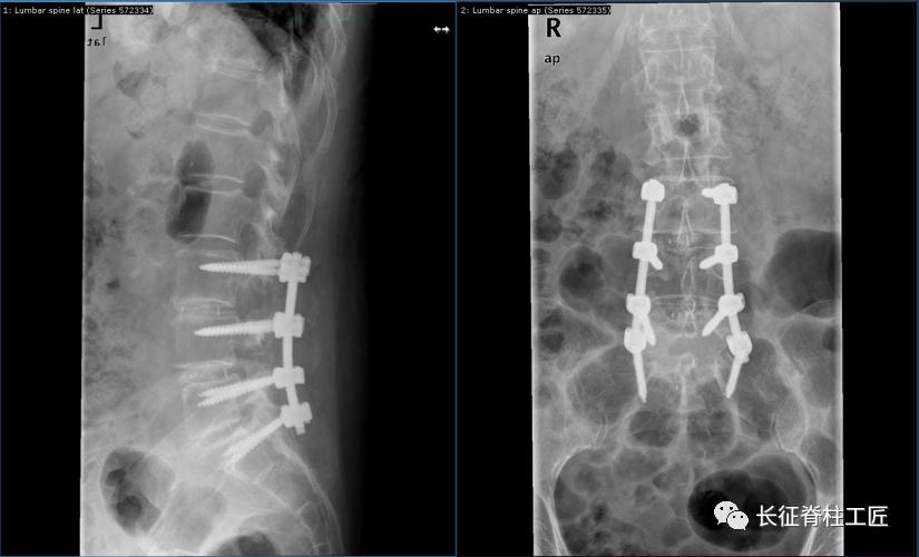 老年人腰椎管狭窄可以微创手术吗,老年人腰椎管狭窄瘫痪