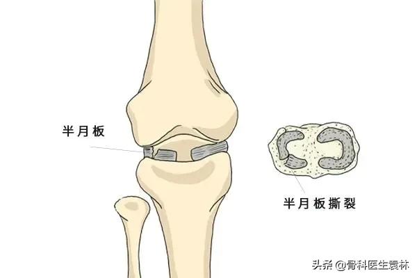 骨质增生到底是怎么回事呢？老人膝关节骨质增生还能治好吗？