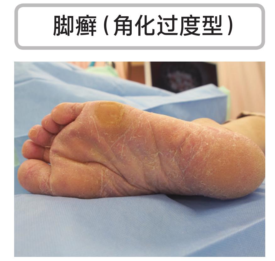 硬邦邦的老茧，会痛的鸡眼，日本皮肤科专家教你矫正足部恶习