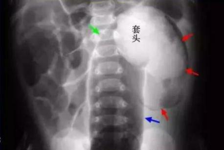小儿急腹症的诊断与处理ppt,小儿急腹症有哪些病种