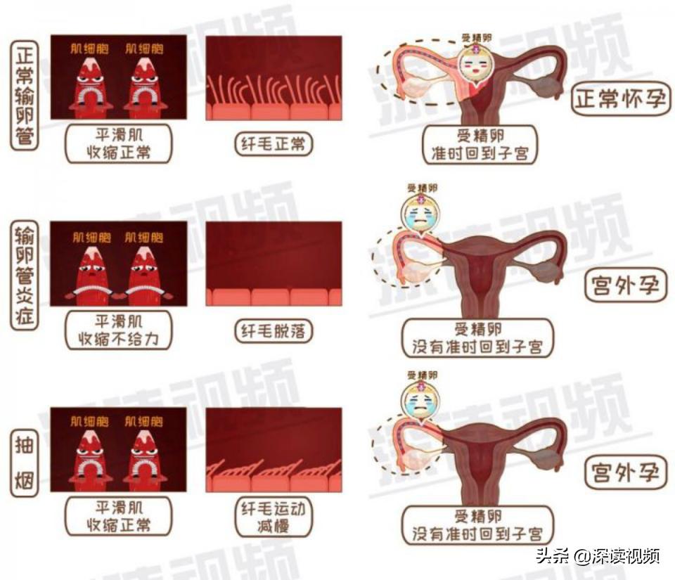 宫外孕出血量和月经一样怎么回事,宫外孕是怎么回事能不能再生孩子