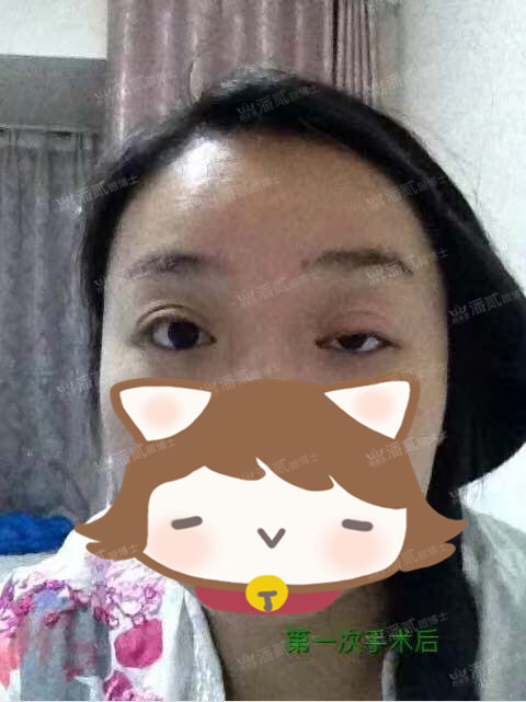 提肌矫正失败的表现眼皮睁不开,做完提肌眼睛前半段下垂