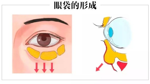 眶隔释放去眼袋为何如此受青睐？原因原来不仅仅是这样