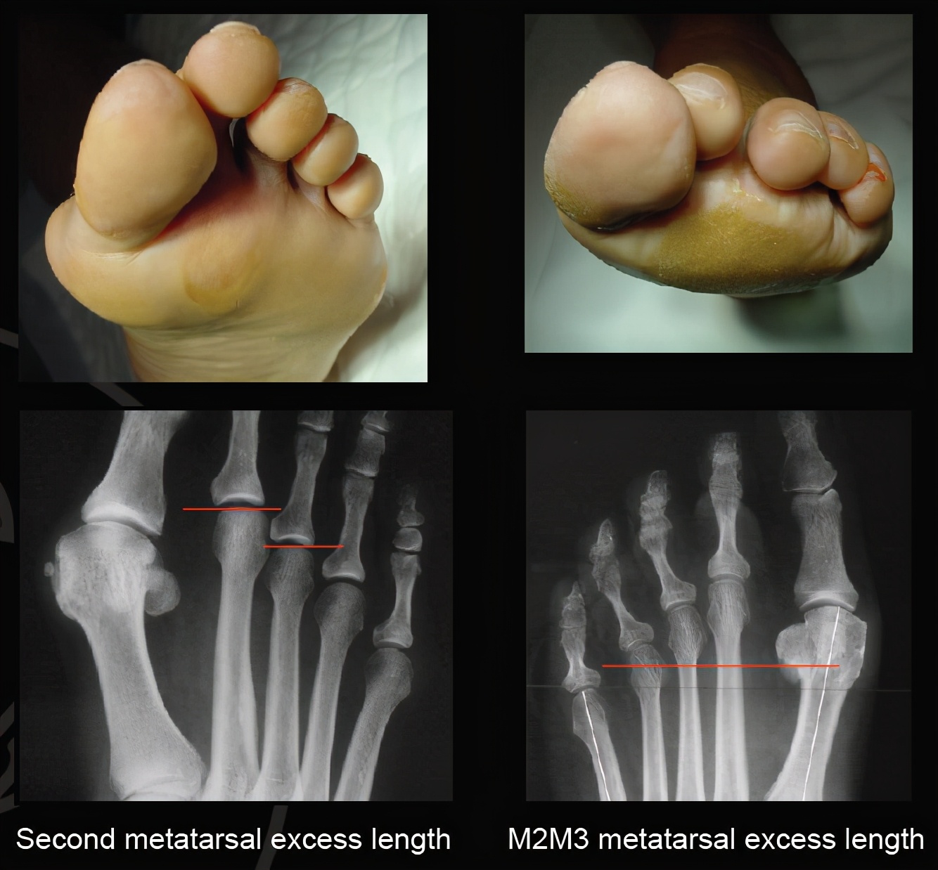 脚底长茧子什么原因,你知道你的脚为什么会麻吗