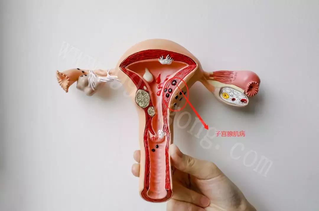 海扶刀®能够治疗子宫腺肌病吗？效果怎么样？