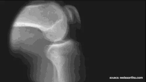 关节咔咔响疼痛怎么治疗,胳膊一动关节就咔咔响是怎么回事