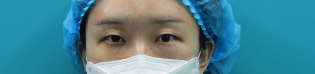 双眼皮前宽后窄算失败吗,双眼皮手术宽度是指恢复后吗