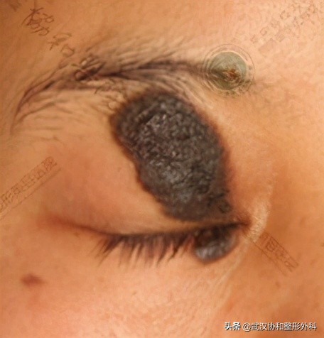 长了很多黑痣是什么原因,不规则的黑痣一定会癌变么