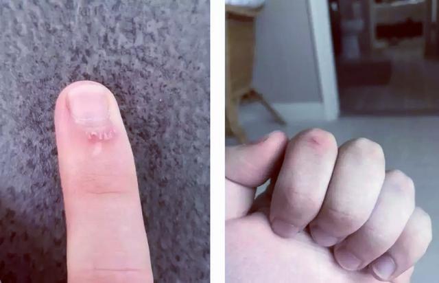 指甲周围长倒刺用什么药,指甲周围长倒刺是缺维生素吗