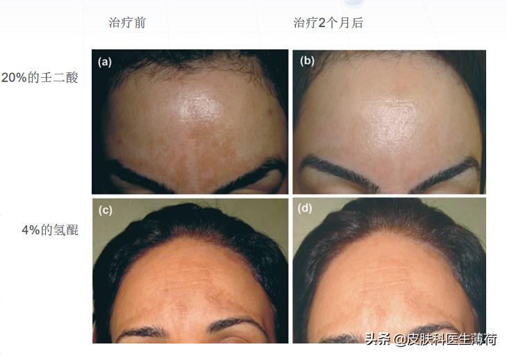 黄脸婆吃什么祛斑,告别黄脸婆自制纯中药祛斑面膜