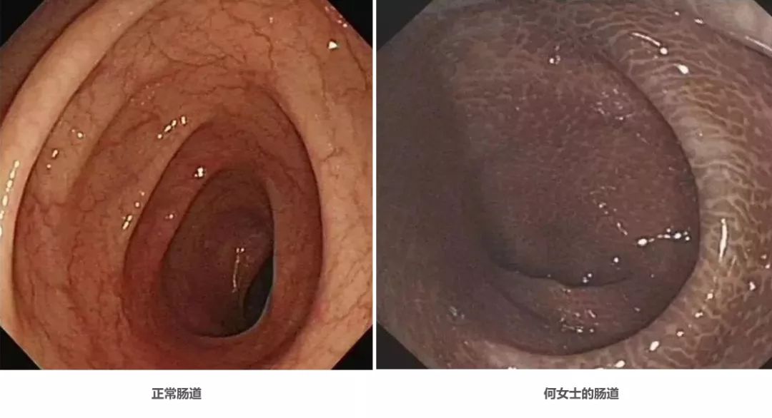 减肥茶喝了反弹,减肥茶喝出黑肠病