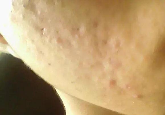 脸上留下的痘坑怎么治,脸上坑坑洼洼痘坑怎么修复