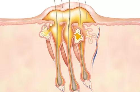 挤完的痘痘,挤痘痘后的正确方式