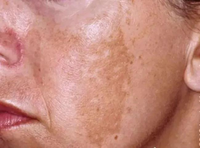 *褐斑黄**、雀斑、黑斑的诊治经验及用方用药一