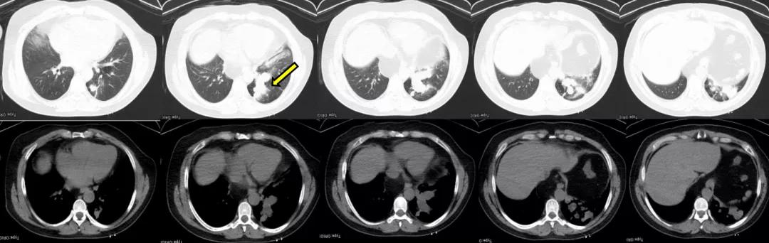 咳嗽10多天了有白痰细菌感染,咳嗽是肺部真菌感染吗