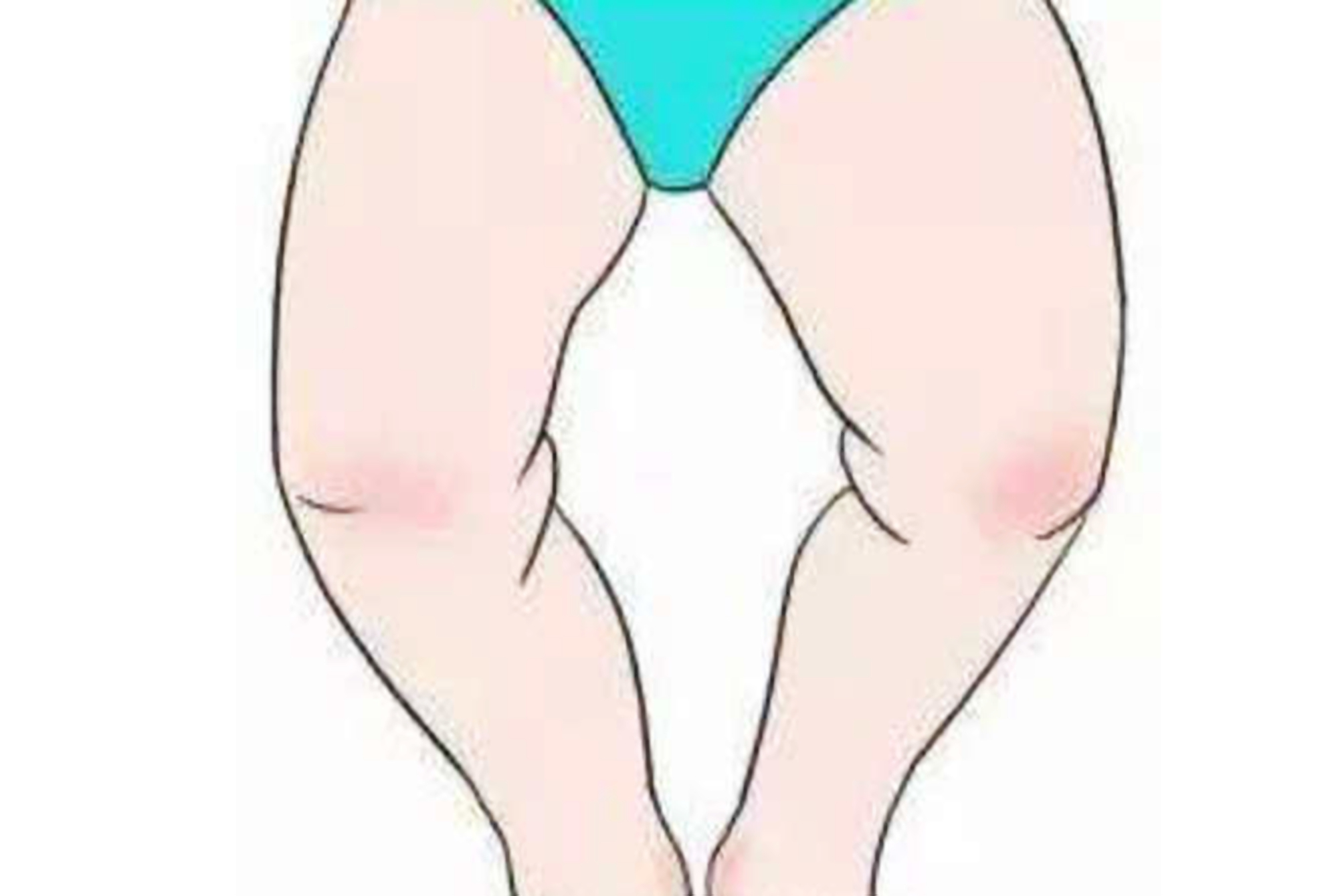 导致孩子罗圈腿的原因,小孩为什么小时候都有点罗圈腿