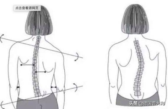 高低肩怎么治疗,高低肩正骨视频