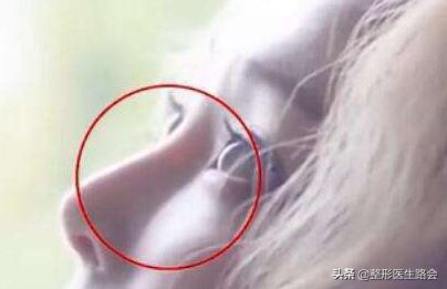 鼻子的鼻梁塌下来了怎么提上来,塌鼻子如何让鼻梁变高变挺