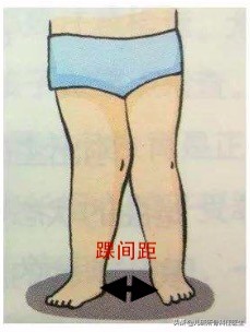 孩子走路太早对腿有什么伤害,宝宝站立早会罗圈腿吗