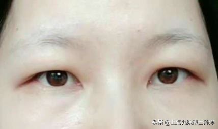 上海九院孙沣博士眼角修复,上海九院美容科孙沣