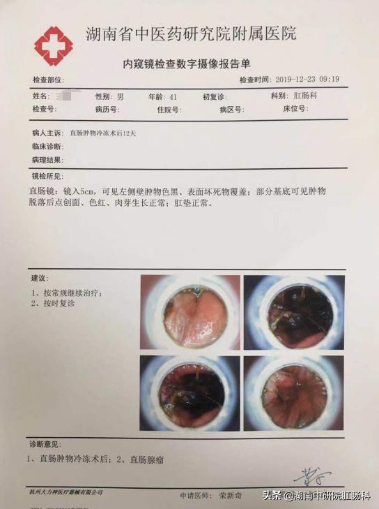 低位直肠癌早期能保肛吗,低位直肠癌晚期治愈吗