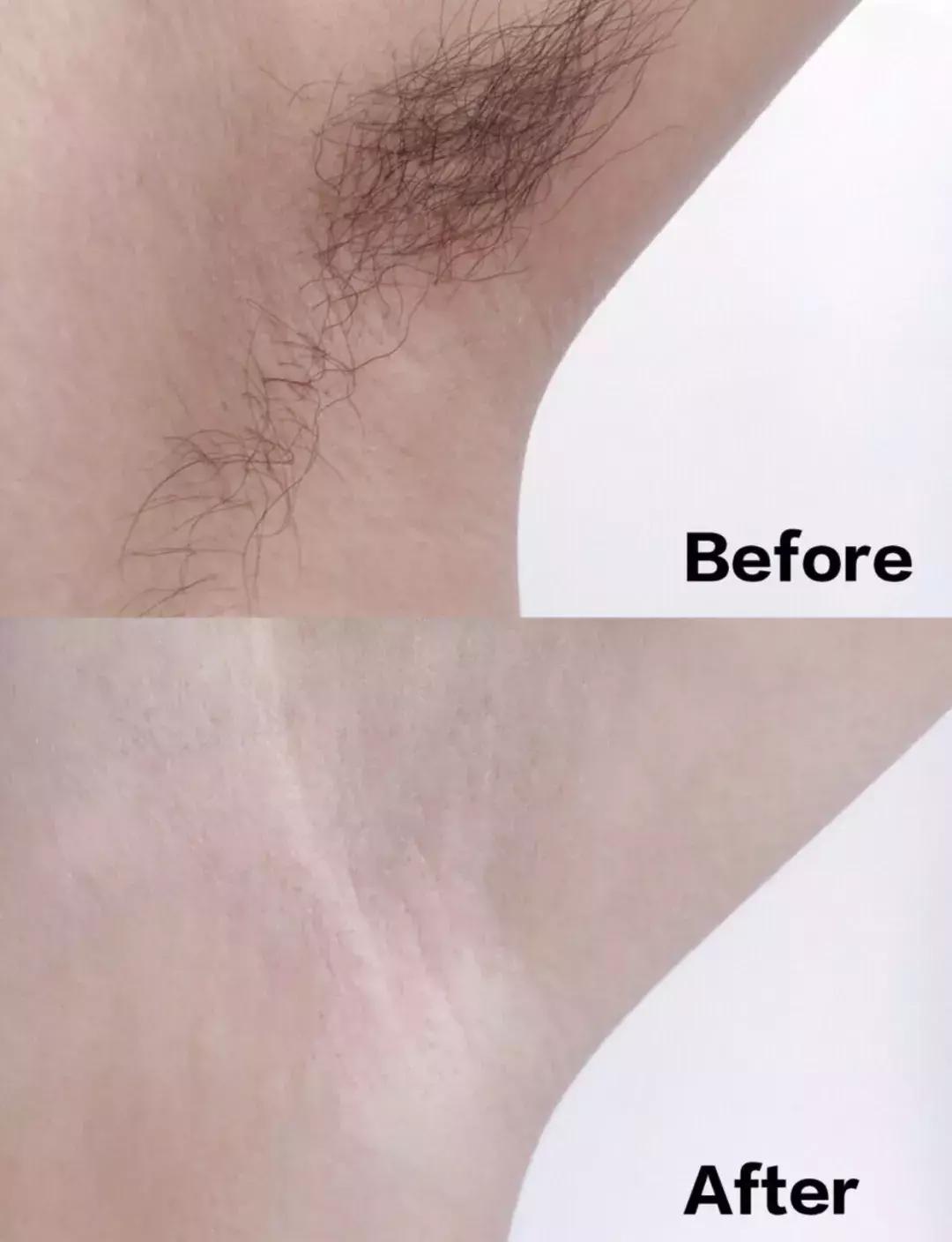 史上最实用脱毛术！夏天再也不为这事发愁啦