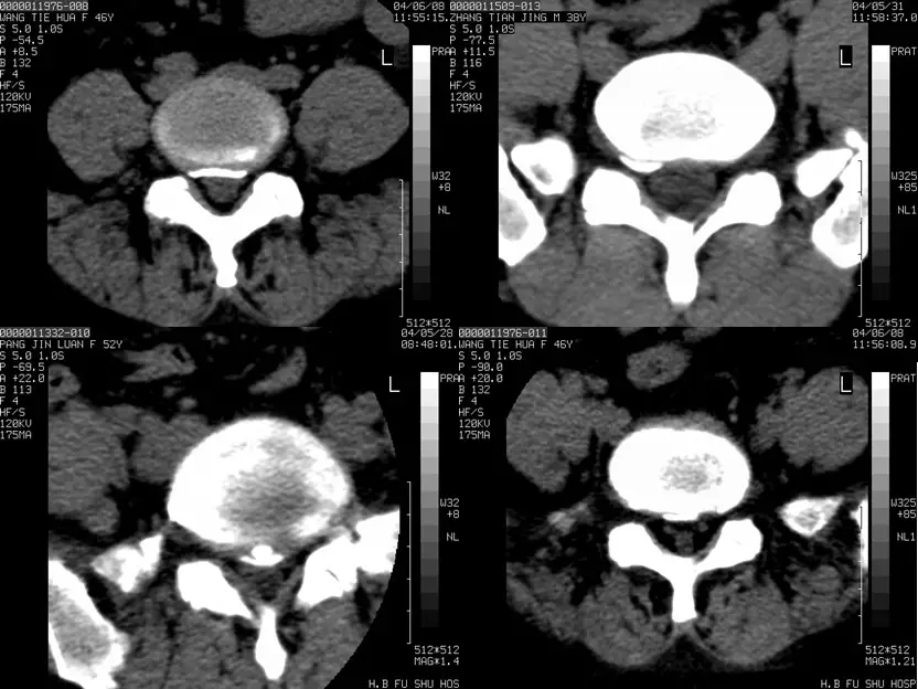 颈椎腰椎疾病ct及mri诊断,腰椎ct可以发现肠部病变吗