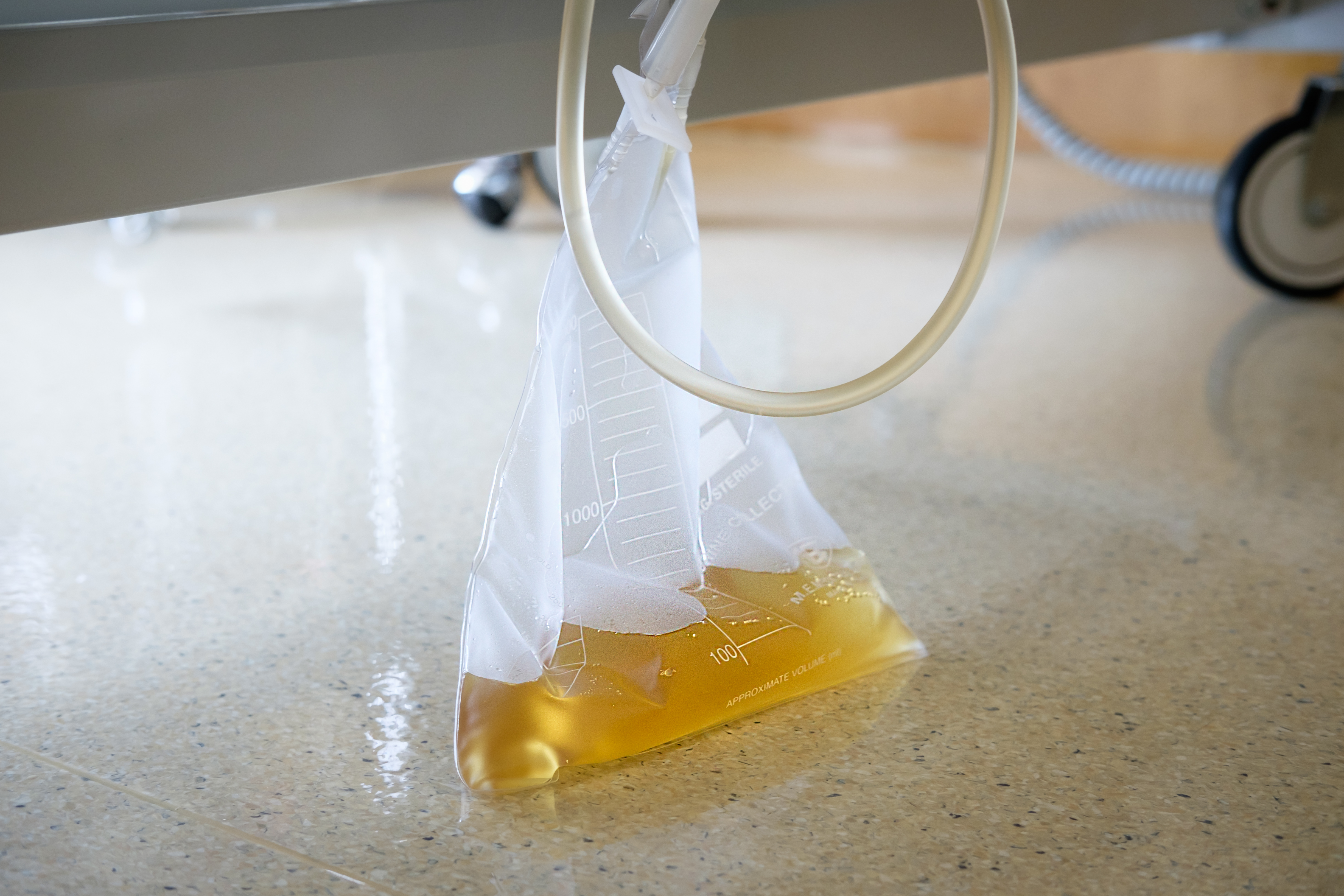 小腹坠疼有小便感觉尿路感染,妇科炎症会引起小便痛吗