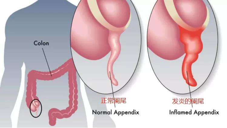 宝宝肚子疼不能大意,宝宝肠胃炎会肚子痛吗