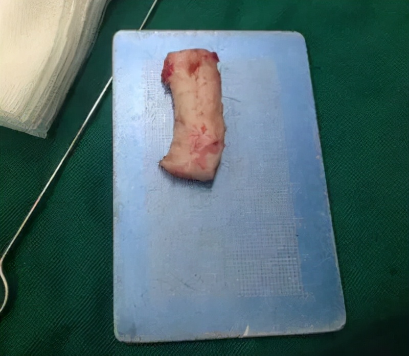 肋软骨隆鼻发生歪斜怎么办,造成隆鼻假体歪斜的原因