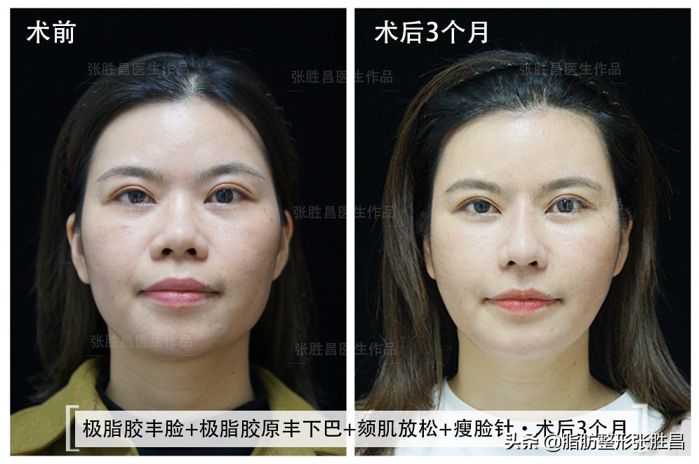 34岁广东女生，颧骨突出显刻薄苦相，脂肪填充后美成人间富贵花
