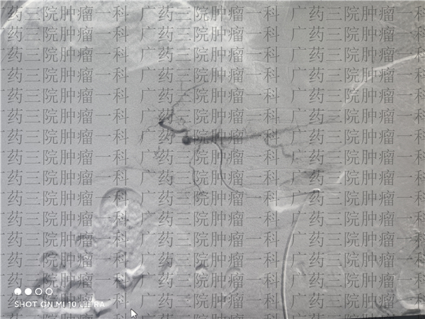 肺癌骨转移中药治疗成功案例,肺癌骨转移中医怎么治