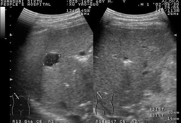 发现肝脏结节要做哪些检查,发现肝部有小结节用治疗吗