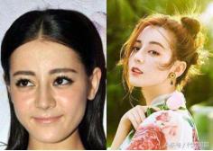 为了变美到底该不该打玻尿酸,玻尿酸注射后变丑了怎么办