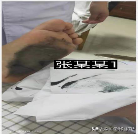 李氏砭法刮痧直播,李氏虎符铜砭刮痧治腰椎间盘突出