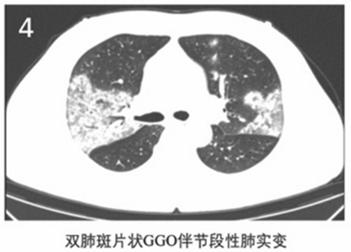 新冠肺炎胸片影像学表现有哪些,新冠肺炎患者轻微症状肺部ct表现