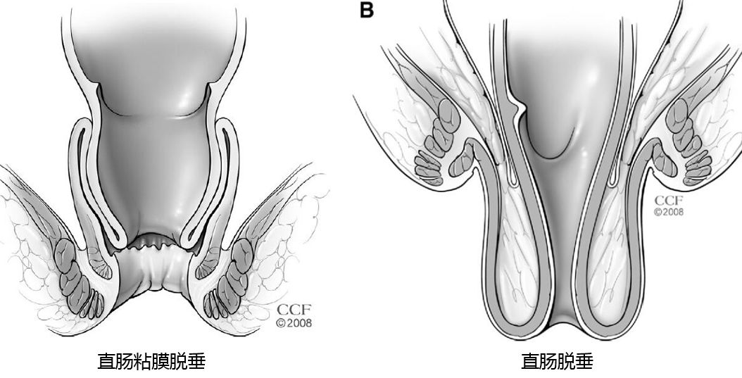 肛门异物感是怎么回事