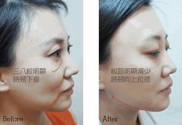 线雕第八天脸更大了,皮肤很松垮能做线雕吗