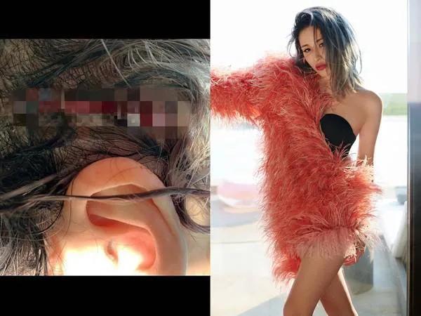 萧亚轩晒昔日头部受伤照片，头部裂开一道口子，伤口触目惊心